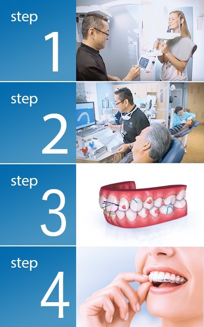 Quy trình Niềng răng Invisalign