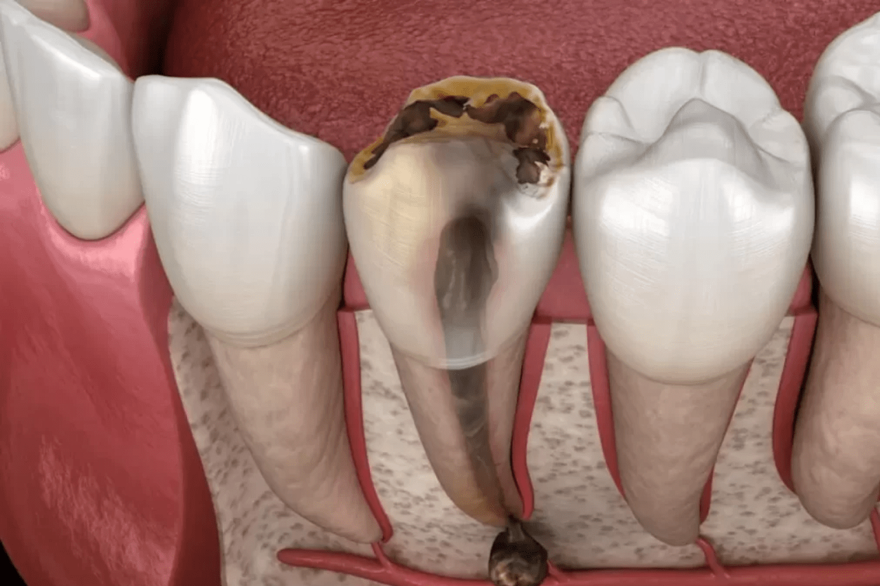 Dấu hiệu của răng chết tủy