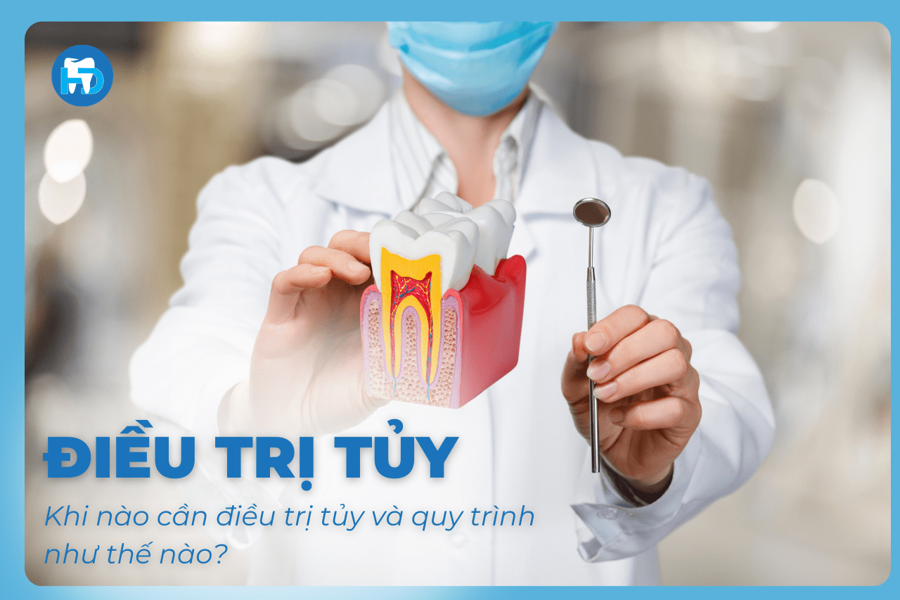 Điều trị tủy là gì_ Khi nào cần điều trị tủy và quy trình như thế nào?