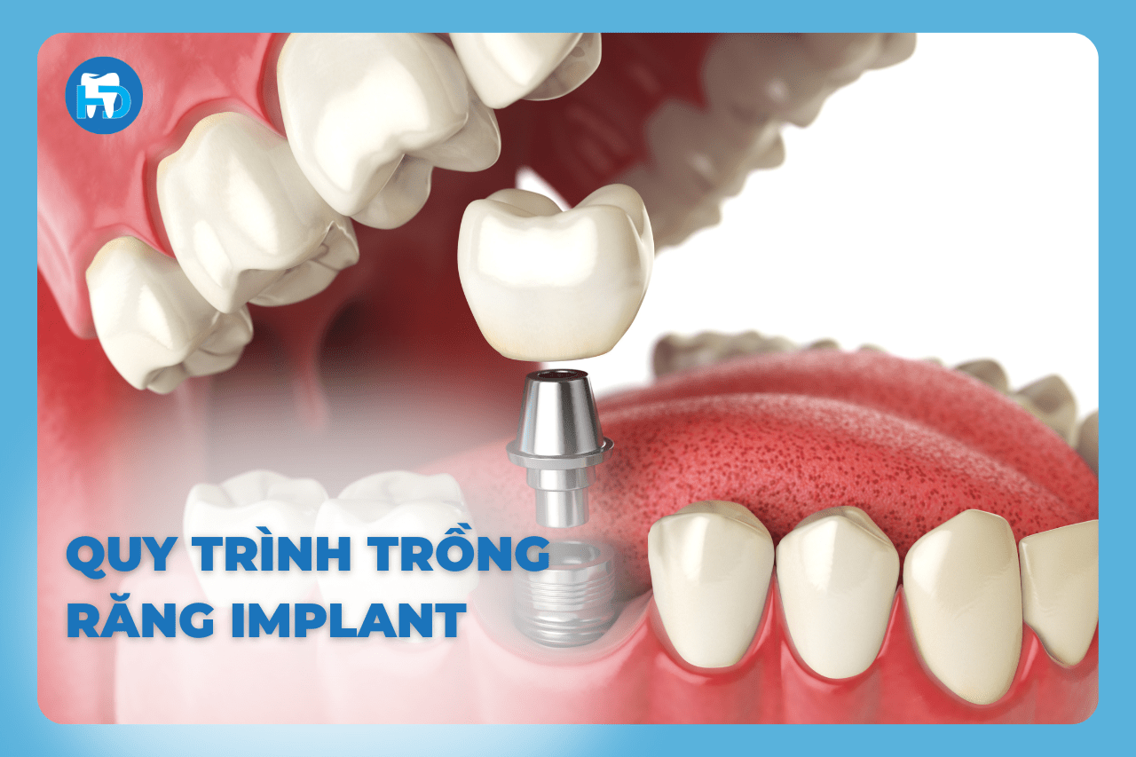 QUY TRÌNH TRỒNG RĂNG IMPLANT DIỄN RA THẾ NÀO