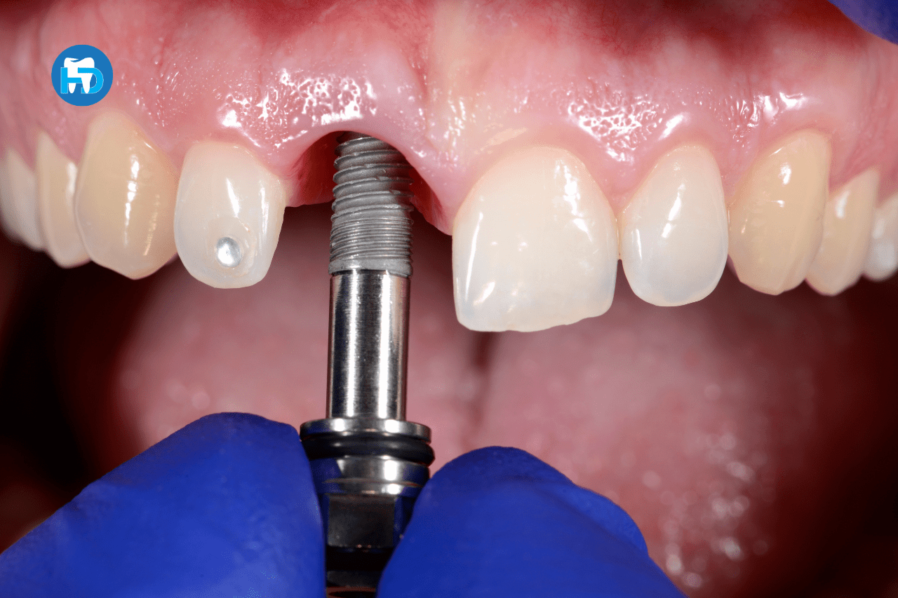 Trồng răng Implant là phương pháp phục hình răng tối ưu nhất hiện nay