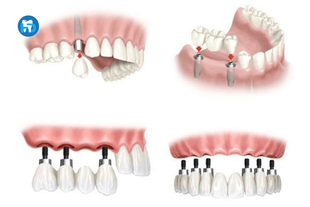 Tùy mỗi vị trí cắm Implant sẽ có mức độ đau khác nhau